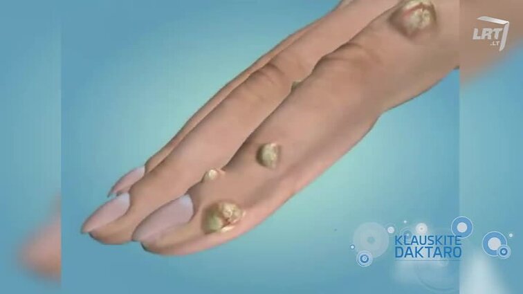 Klauskite daktaro Koks geriausias būdas karpoms naikinti? Skausmas krūtinėje: kada tai – širdies problemos, o kada – nugaros?