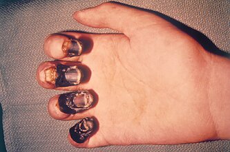 Buboninio maro sukelta galūnių gangrena Buboninio maro sukelta galūnių gangrena