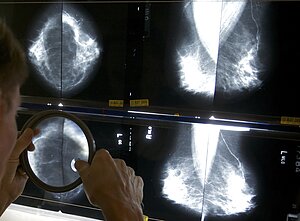 Krūties vėžio diagnozavimas