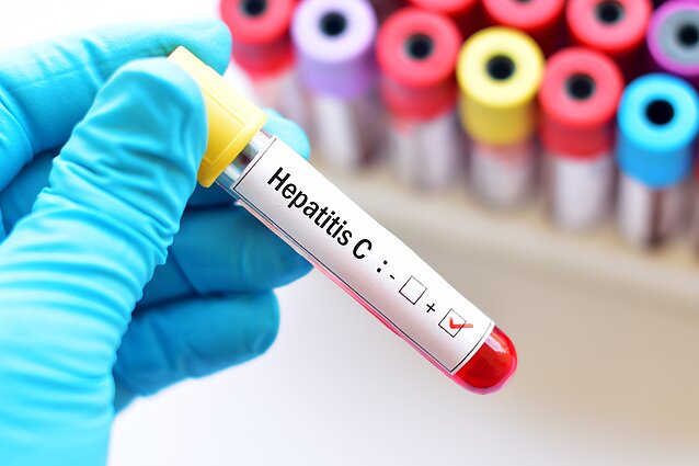 Hepatitas C Hepatitas C