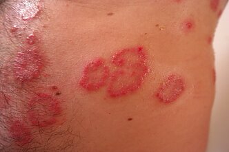 Psoriazė. Odos ligos