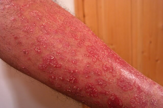 Psoriazė. Odos ligos