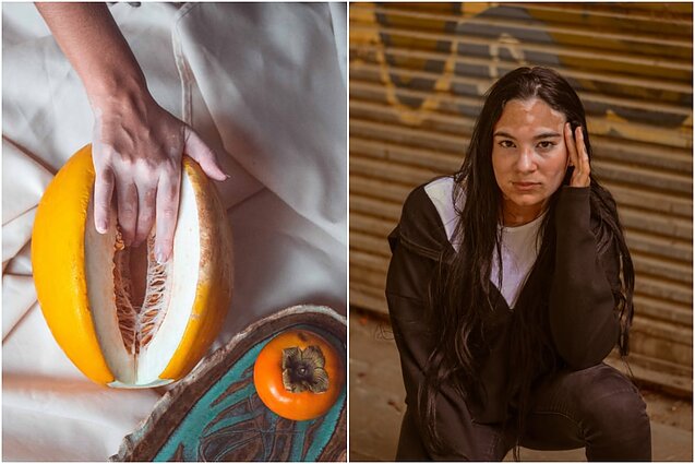 Baltmė – mistifikuota odos liga apie kurią žinome per mažai: kaip ji veikia kasdienį sergančiųjų gyvenimą?