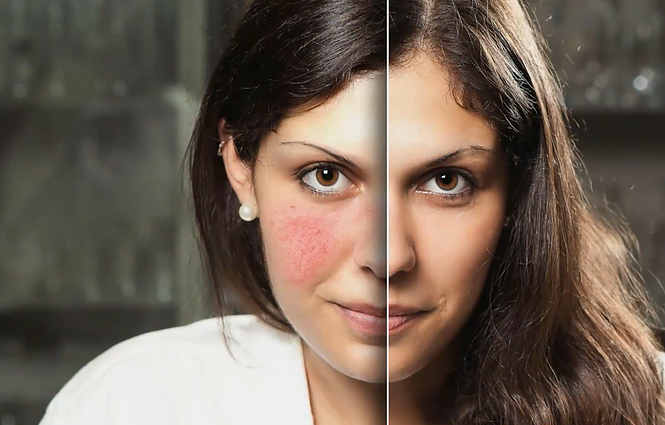 Veidą išmušantis raudonis gali tapti rimta odos problema: daktaras atskleidžia, kaip kovoti su rožine