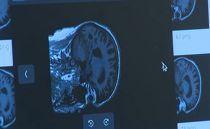 KTU mokslininkai sukūrė algoritmą, padėsiantį efektyviau nustatyti Alzheimerį: liga atpažįstama 99 proc. tikslumu