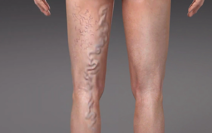 Venų varikozė