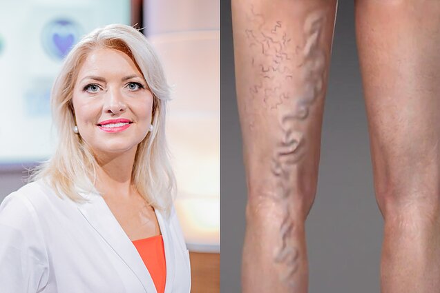 Jurgita Plisienė, venų varikozė. Asociatyvus koliažas Jurgita Plisienė, venų varikozė. Asociatyvus koliažas