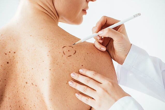 Minint pasaulinę melanomos dieną – medikų raginimai prevenciškai pasitikrinti: tai nėra tik vyresniųjų liga