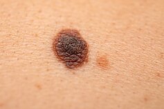 Melanoma Melanoma