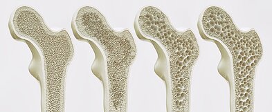 Osteoporozė Osteoporozė