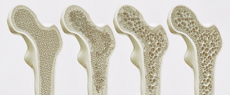Osteoporozė Osteoporozė