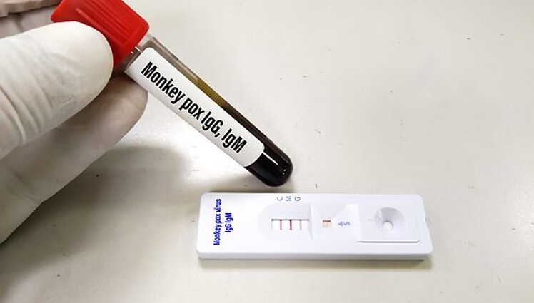 Žinios. Latvijoje patvirtintas pirmasis žmogaus užsikrėtimas beždžionių raupais