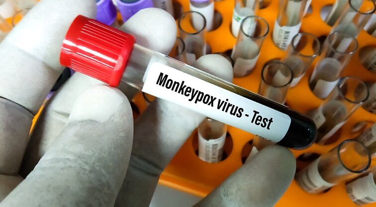 Beždžionių raupai: pirmasis ėminys Lietuvoje neigiamas