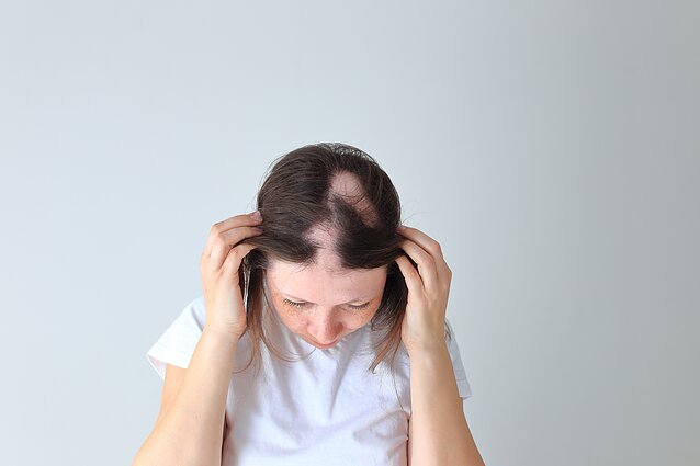 Alopecija