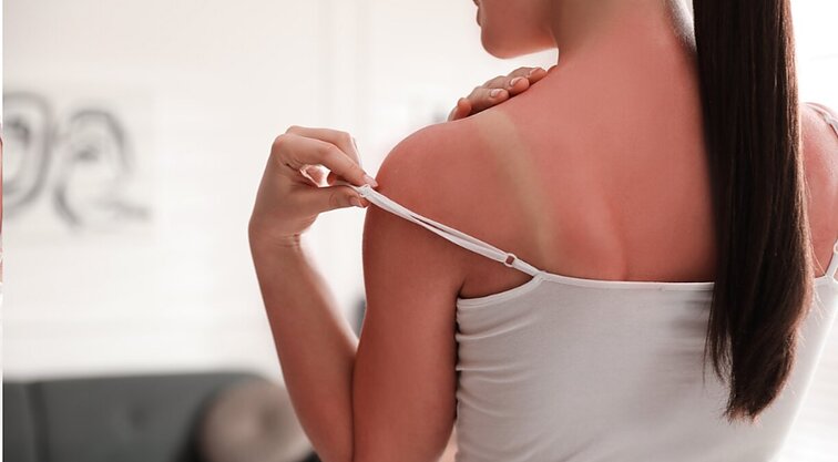 Nudegimai saulėje, nubrozdinimai ir vabzdžių įgėlimai: kaip teisingai juos gydyti?