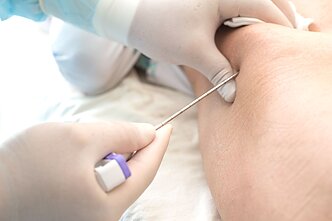 Onkologas perveria vaiko klubą, kad nustatytų, ar kaulų čiulpuose nėra leukemijos, Ewing sarkomos Onkologas perveria vaiko klubą, kad nustatytų, ar kaulų čiulpuose nėra leukemijos, Ewing sarkomos