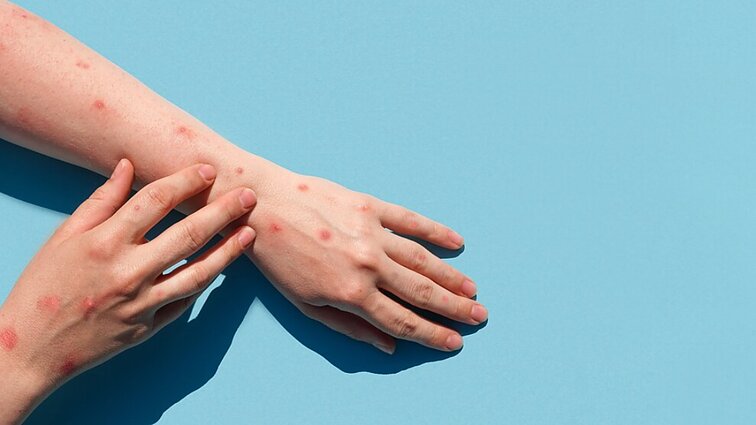 Lietuvoje patvirtintas pirmasis beždžionių raupų atvejis: užsikrėtęs 40–49 m. amžiaus vyras atvyko iš kitos Europos šalies