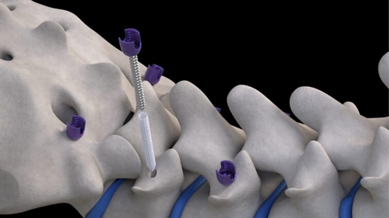 Inovatyvus implantas žada perversmą stuburo chirurgijoje Inovatyvus implantas žada perversmą stuburo chirurgijoje