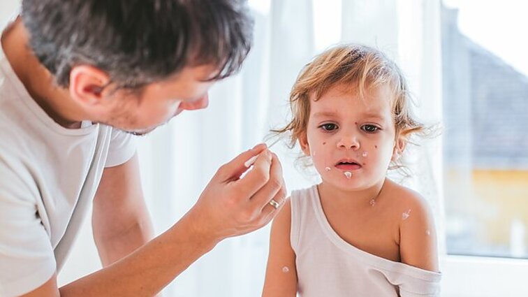 Epidemiologė – apie vėjaraupių komplikacijas, ar galima susirgti antrą kartą ir kam vertėtų skiepytis