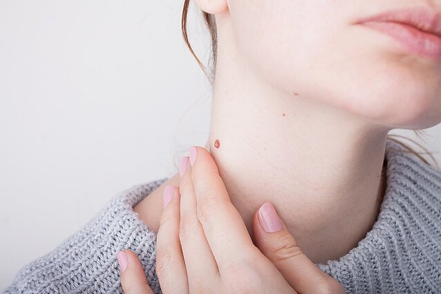 Gydytoja įvardijo, kokie požymiai išduoda melanomą: dariniai gali išsiplėsti ir per kelias savaites