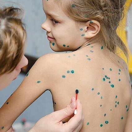Sveikata. Kas sukėlė vėjaraupių bangą Lietuvoje?