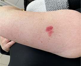 Melanoma Melanoma