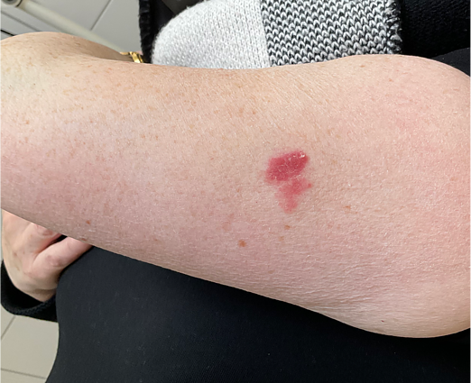 Melanoma Melanoma