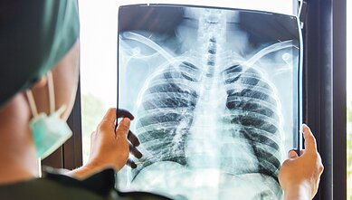 Plaučių rentgenas, asociatyvi nuotr.