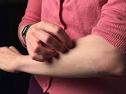 Niežų prevencija ir gydymas: kokių priemonių imtis, pastebėjus pirmus simptomus?