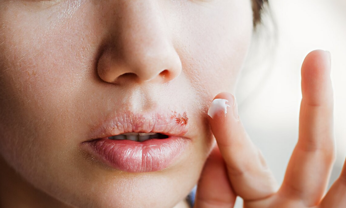 Daktarė apie lūpų pūslelinę: ši liga – signalas, kad reikėtų pristabdyti darbus ir susirūpinti sveikata