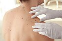 Melanoma, asociatyvi nuotr.