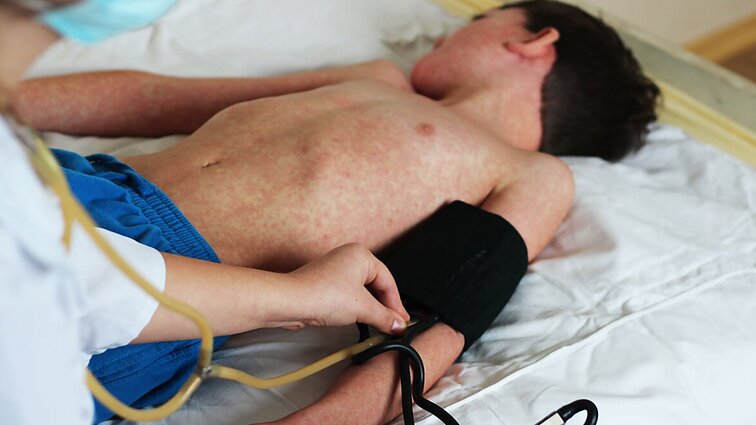 Tymų susirgimų Lietuvoje daugėja: specialistė įspėja – užsikrečia ne tik vaikai