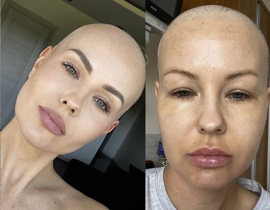 I. Burlinskaitė Kauno klinikose kovoja su onkologine liga