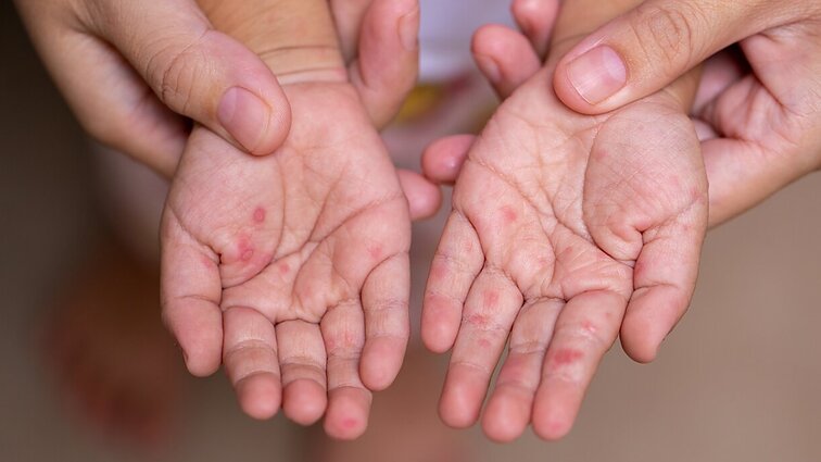 Dėl vaikų neskiepijimo sugrįžta pamirštos ligos: Razmuvienė teigia – trūksta tėvų sąmoningumo