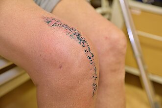 Pacientas po kelio sąnario endoprotezavimo