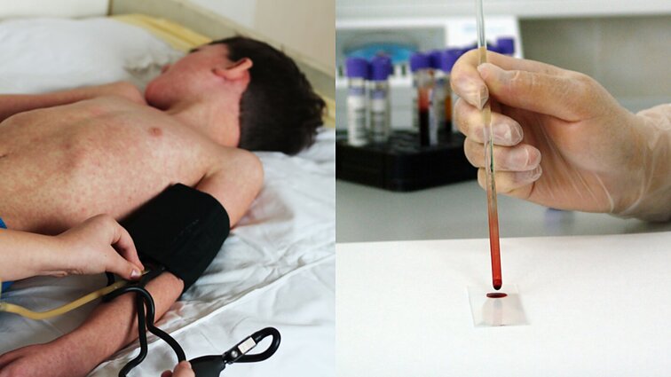 „Pasirodo kaip paprasčiausias virusas“: plintant tymams, gydytojai primena tirtis