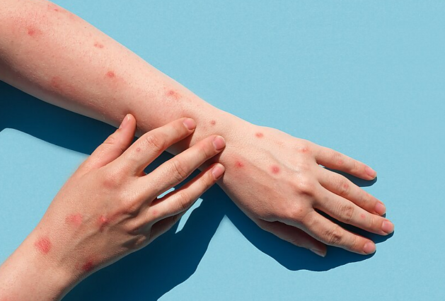 Čaplinskas apie beždžionių raupų atvejus Europoje: pavojus, be abejonės, egzistuoja