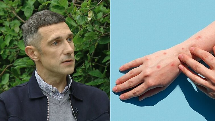 Sveikatos specialistas apie beždžionių raupus: tokios situacijos kaip Afrikoje neturėsime