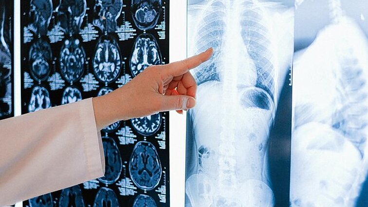 Kokliušas arba „100 dienų kosulio“ liga: simptomai ir galimos komplikacijos