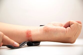 Alerginis kontaktinis dermatitas Alerginis kontaktinis dermatitas