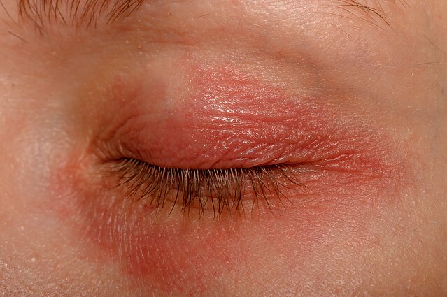 Alerginis kontaktinis dermatitas Alerginis kontaktinis dermatitas