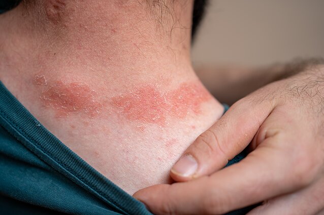 Alerginis kontaktinis dermatitas Alerginis kontaktinis dermatitas