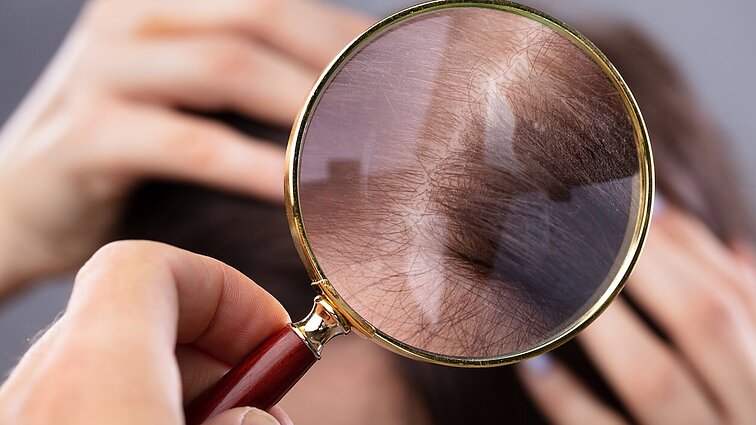 Ekspertai griauna utėlių mitus: užsikrėtimo nelemia socialinis statusas ar plaukų ilgis