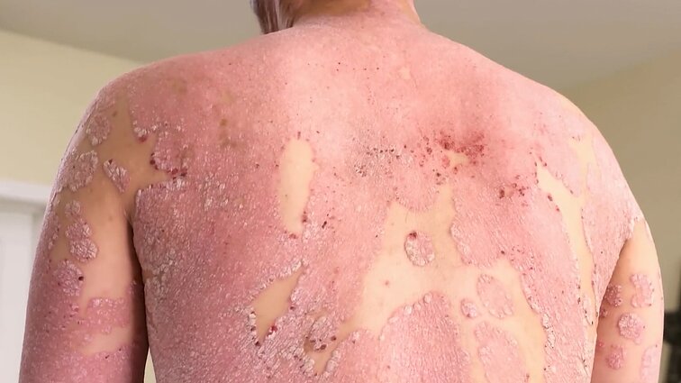 Klastinga ir nepagydoma žvynelinė: kaip ligą diagnozuoti ir su ja gyventi lengviau