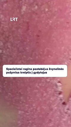 Klastinga ir nepagydoma žvynelinė: kaip ligą diagnozuoti?