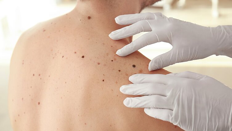 Melanoma vystosi ne tik apgamuose: odos vėžys gali atsirasti ir sveikoje odoje