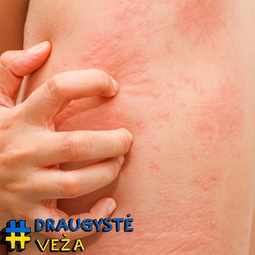Gydytojai alergologai – tarsi detektyvai