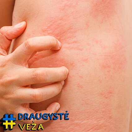 Gydytojai alergologai – tarsi detektyvai