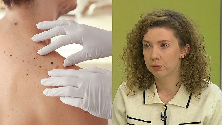 „Nepamirškit ir tarpupirščių“: gydytoja atsakė, į kokius odos pakitimus atkreipti dėmesį