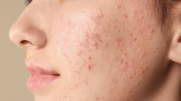 Specialistė apie su odos ligomis susijusius mitus: tik nedidelė dalis yra užkrečiamos